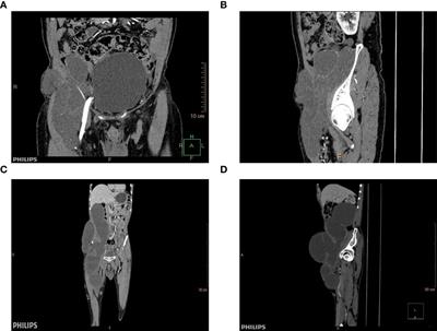 Extra-abdominal growth of a large low-grade appendiceal mucinous tumour through the femoral canal–a rare case report